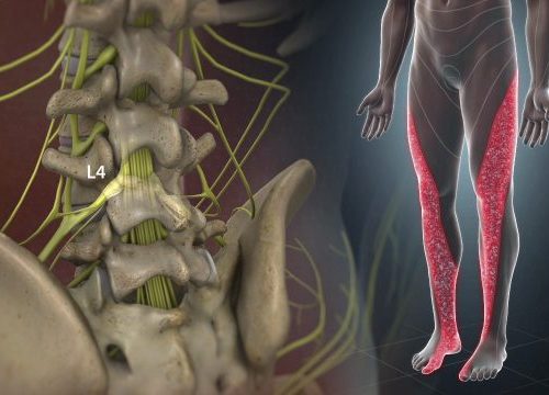 lumradsciatica_1280-584x360